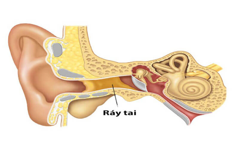 moc ray tai bi chay mau